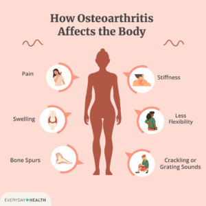 Menopause and Osteoarthritis: How end of reproductive cycle can increase musculoskeletal risks amongst women