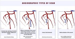 SCAD Explained – A Closer Look at Spontaneous Coronary Artery Dissection