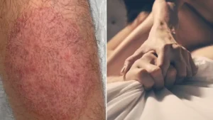 Rare Fungus Outbreak In NYC: CDC Links Contagious Rash To Sexual Contact