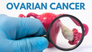 Study Highlights Changing Global Patterns In Ovarian Cancer By Region And Subtype