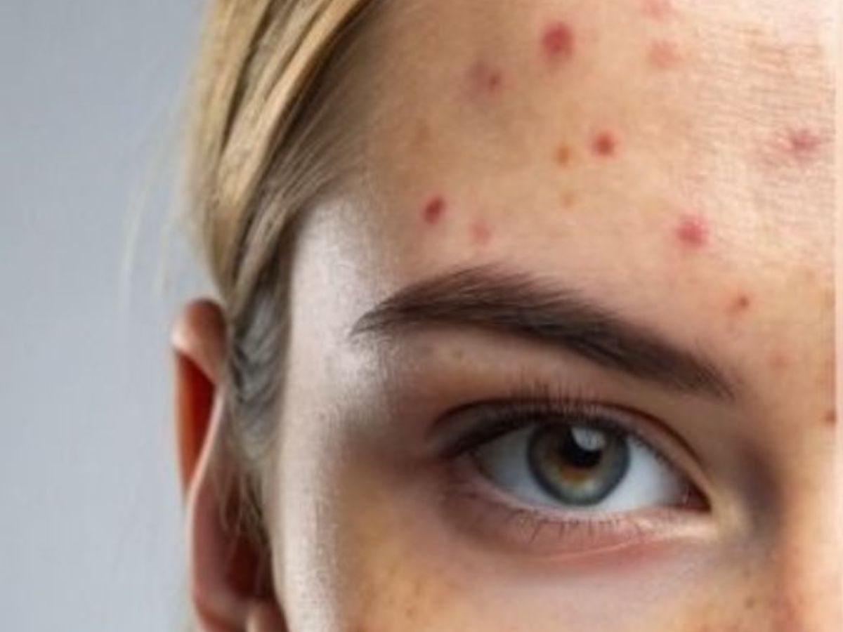 Acne breakouts on face - Photo Gallery
