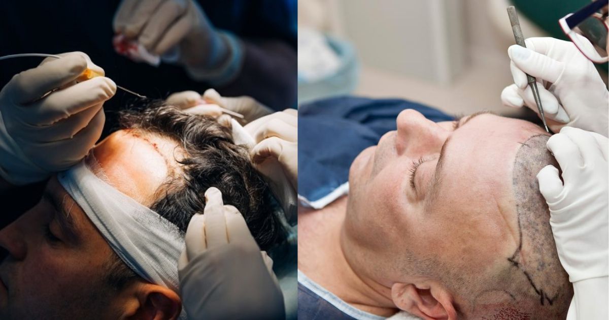 Cheaper Hair Transplant Turns Deadly: British Man Dies After 5-Hour Procedure in Turkey