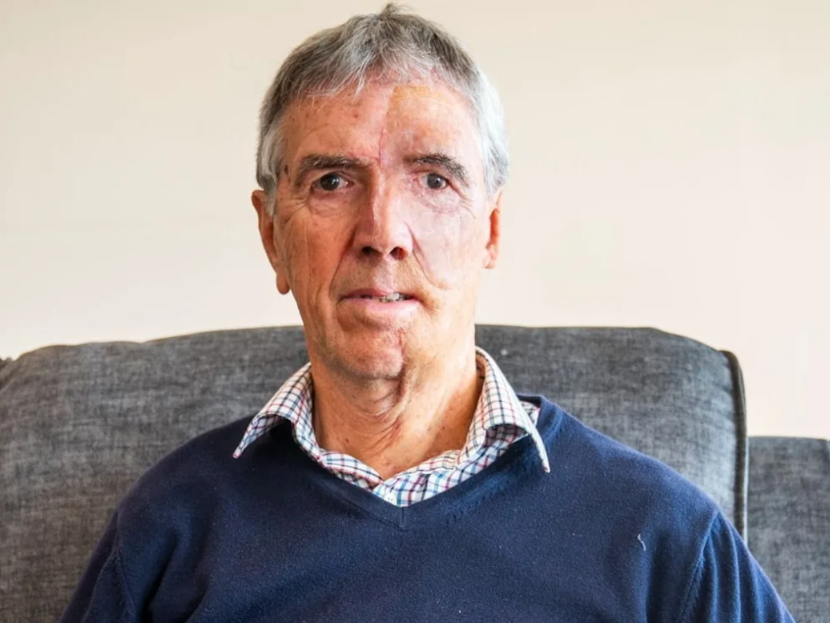 Cyclist Who Lost Eye In Drunk Driving Crash Fitted With 3D-Printed Face