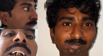 Who is Rajendra Panchal, 38-Year Survivor of Rare Jaw Condition Mocked on Social Media? Crypto Platform Issues Apology