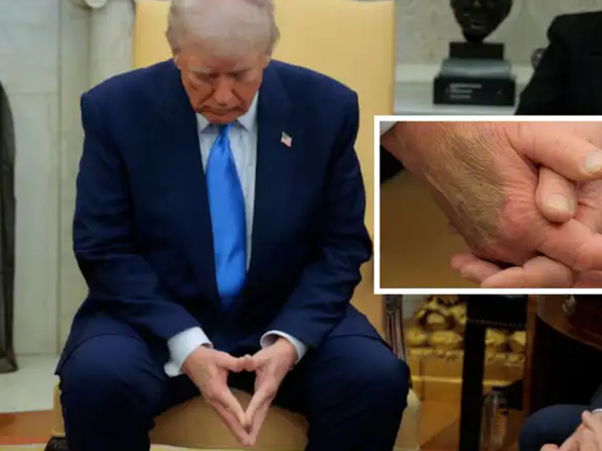 ‘Perfect’: Trump Explains Bruised Hand, Rejects Falling Asleep Allegations During Public Meetings
